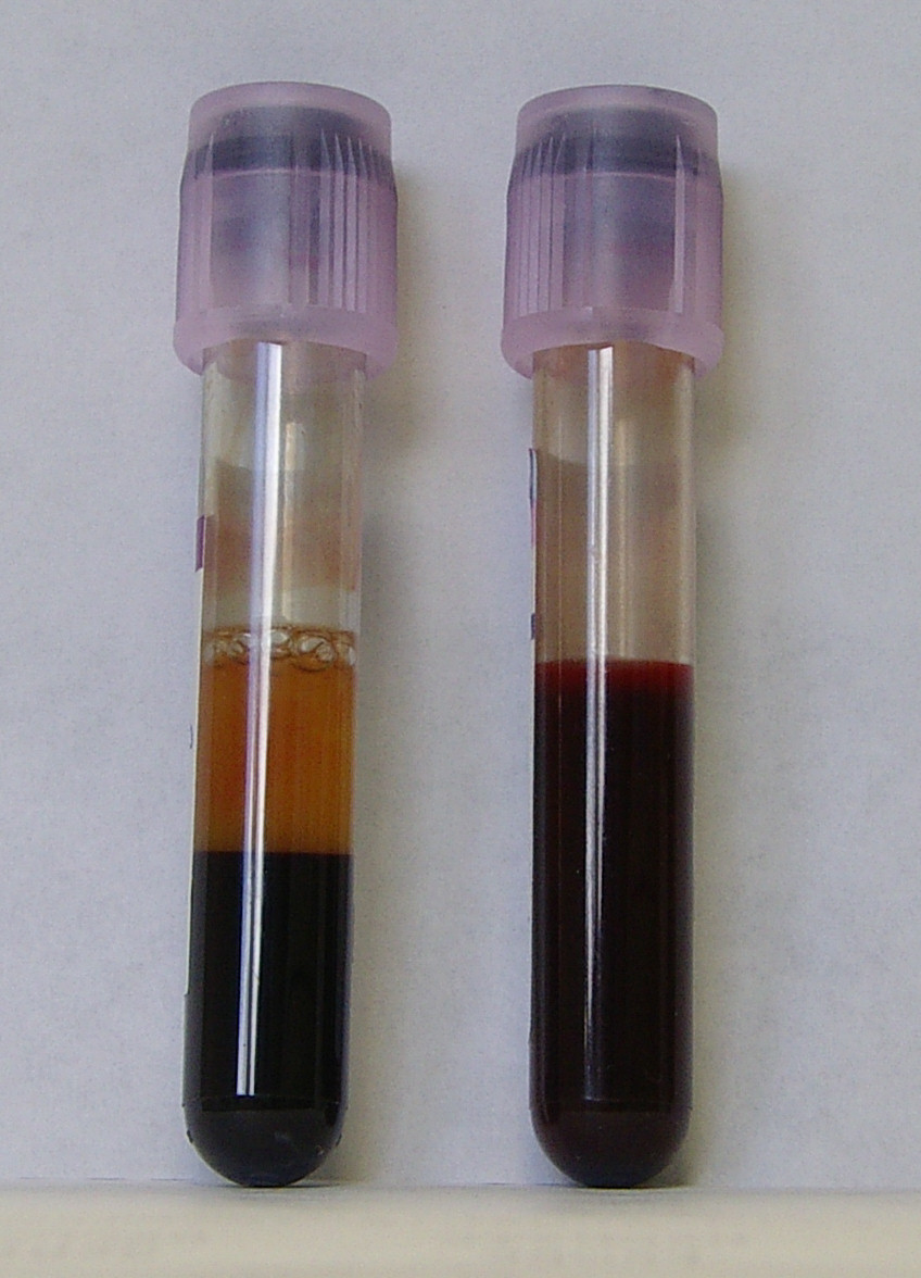 Exemplo de um processo de amostragem: coleta de uma amostra de sangue. Fonte: Wikipedia (CC BY-SA-3.0).