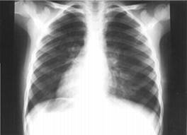 Exemplo de uma imagem de Raio X do pulmão.